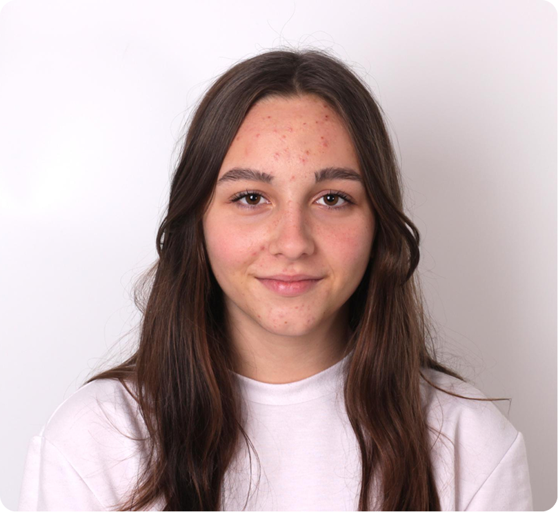 Best care for long-term acne health