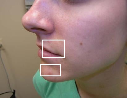 1 Week of Treatment